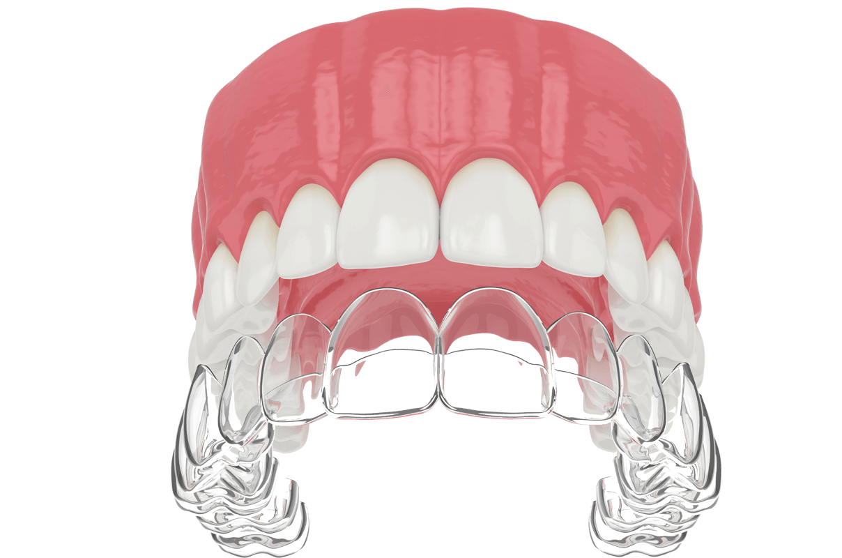 aligner-2 - orthoclear